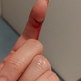 Faulty bin lid.BEWARE when pressing button to open